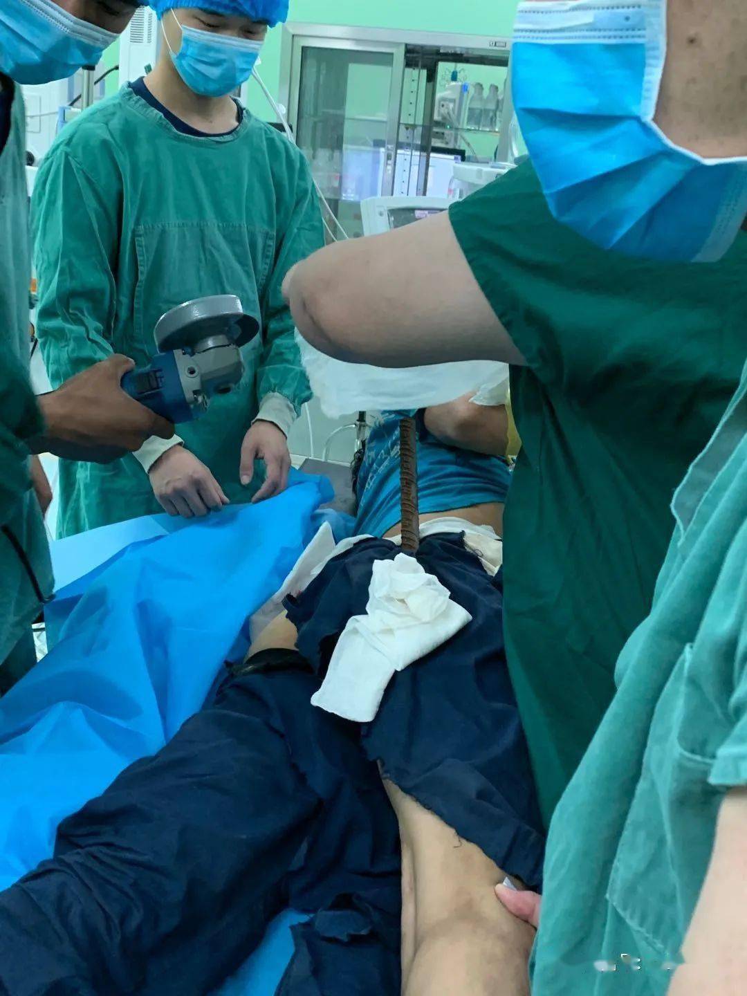 触目惊心五米高空坠落被一米多钢筋刺入体内