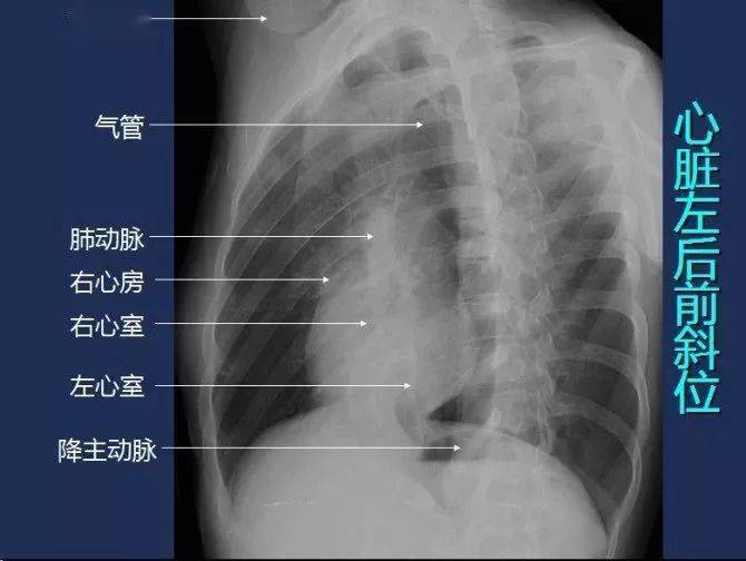 胸片数肋骨图解图片