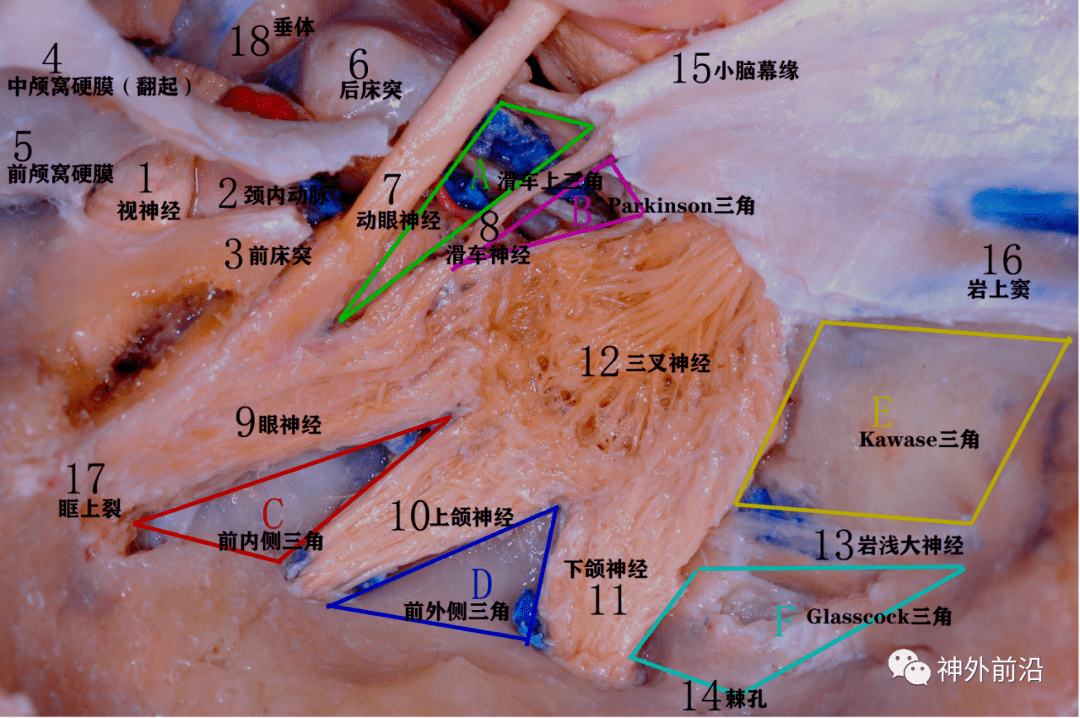 b 动眼神经三角c 内下三角d 外下三角9 斜坡10 中颅窝底硬膜a前床突