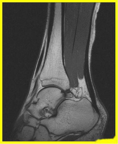 mri可现实跟腱腱鞘周围肿胀,退行性变和跟腱大片撕裂.