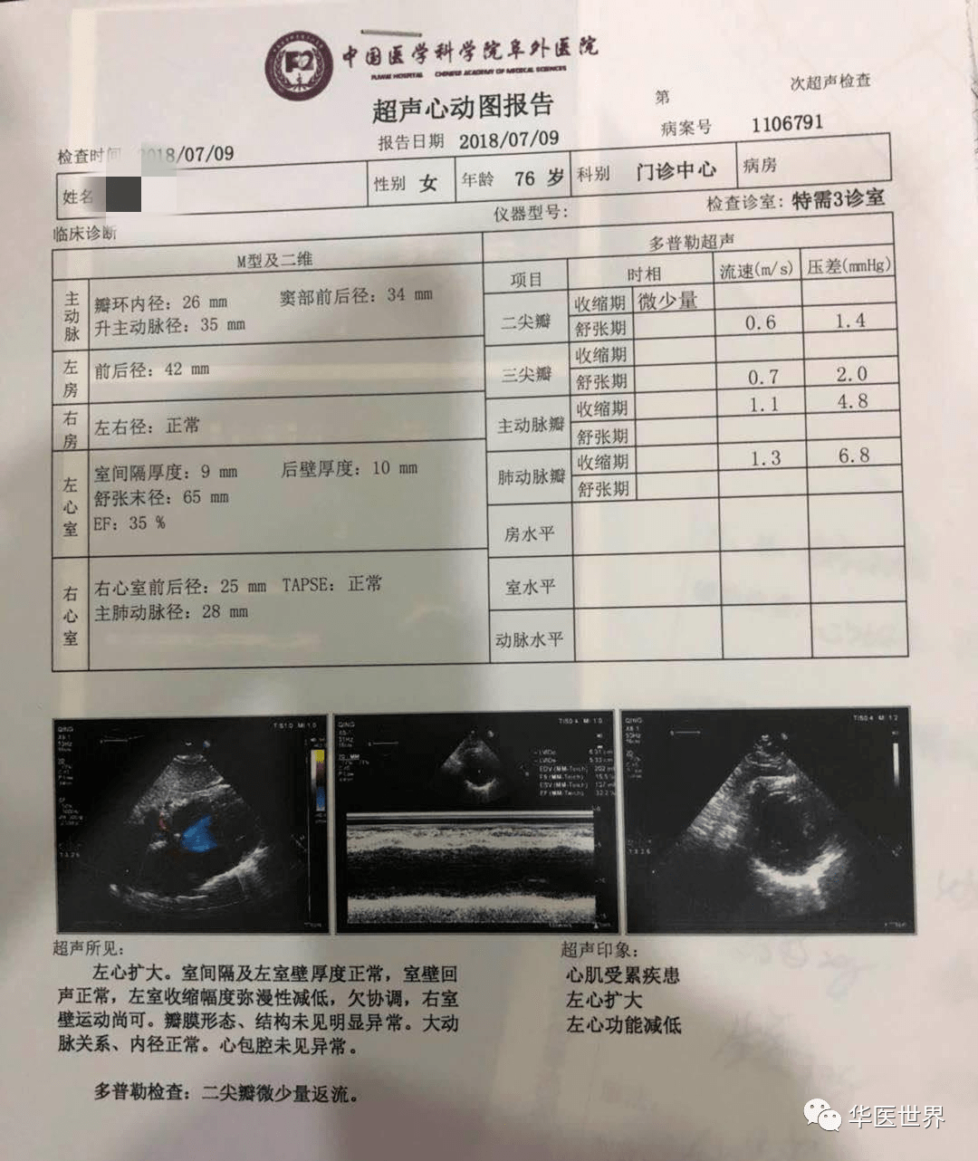 【最新教学视频】扩张型心肌病,王庆国教授用苓桂术甘汤治好了