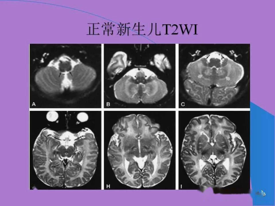 新生儿缺氧缺血性脑病的mri诊断