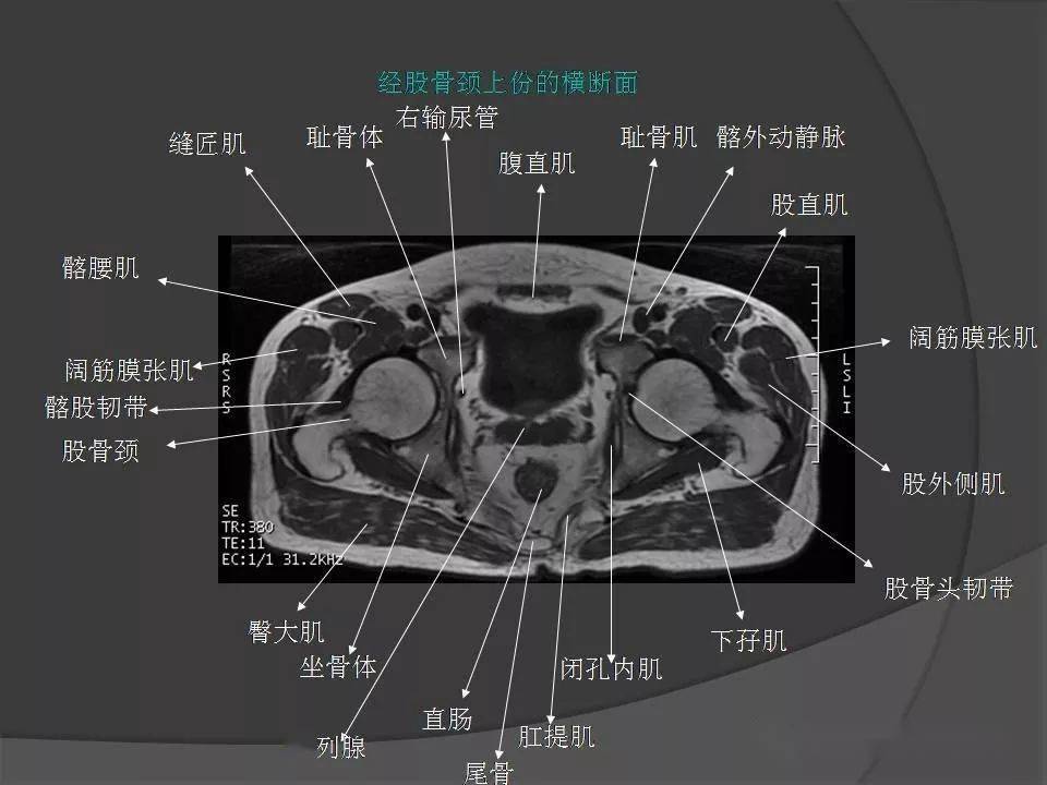骨盆肌肉解剖mri标识