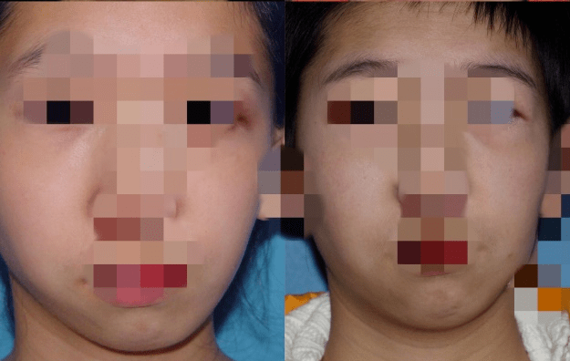 歪脸女孩美丽蜕变这样的整形手术是怎么做到的