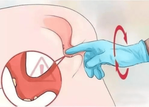 肛肠知识 | 肛肠科"一指神功",有你意想不到的效果_肛门