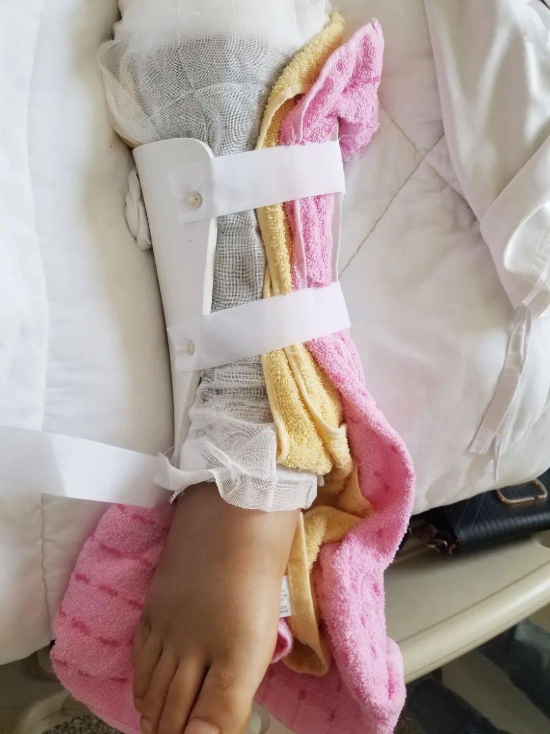 中医中药显神威中西医结合治疗骨折在聊城市二院创伤骨科率先开展