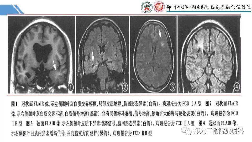 局灶性腦皮層發育不良