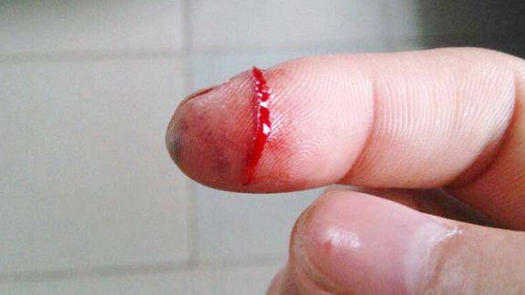 手指割破后放进嘴里舔一舔真的科学吗