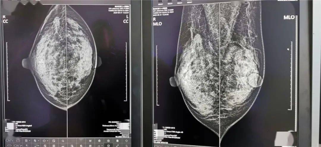 新院资讯新医院首台调试完毕设备乳腺数字钼靶机