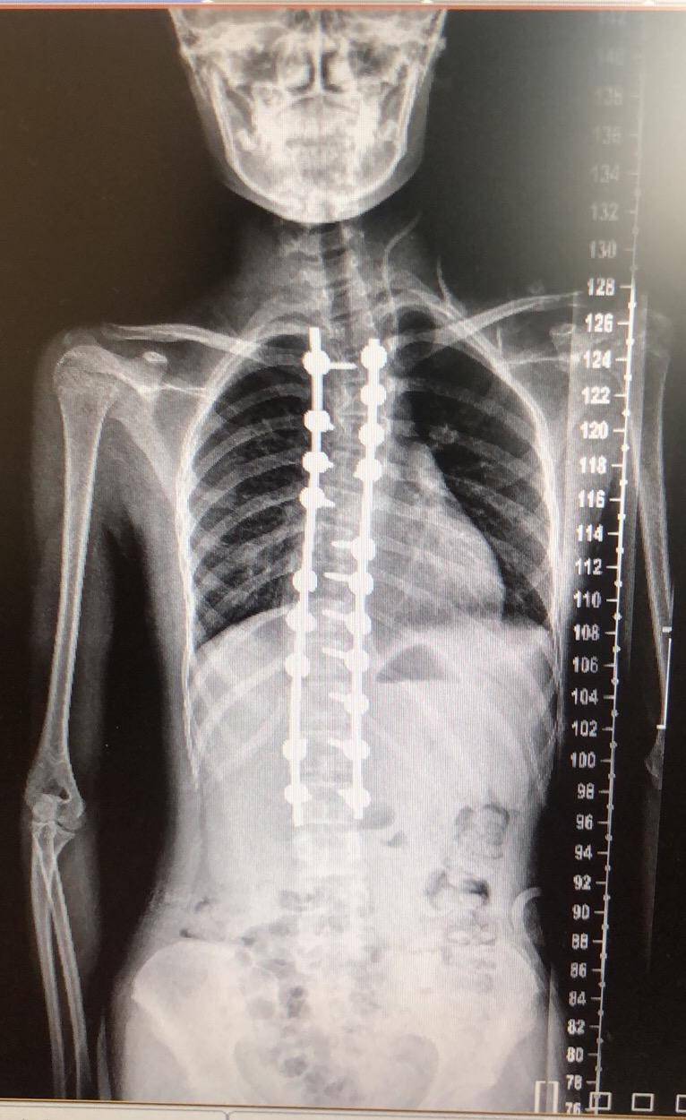 南医三院将对1568名脊柱侧弯青少年进行义诊帮扶