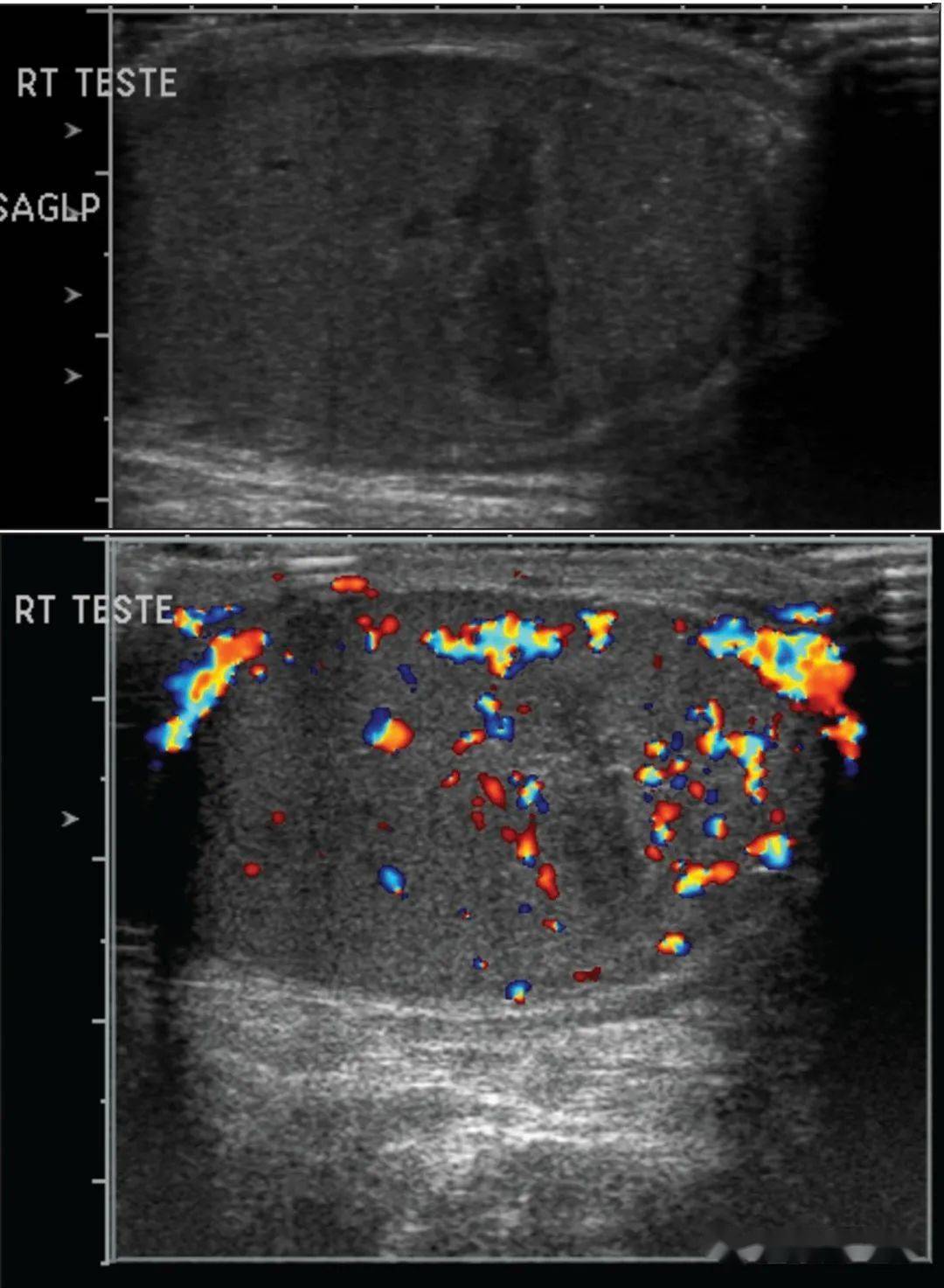 节段性睾丸梗塞令人尴尬的楔形