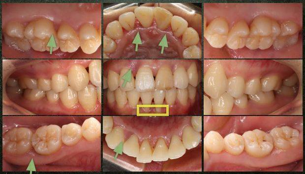 局限型侵袭性牙周炎及牙龈退缩治疗病例分享