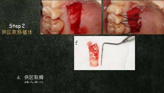 侷限型侵襲性牙周炎及牙齦退縮治療病例分享