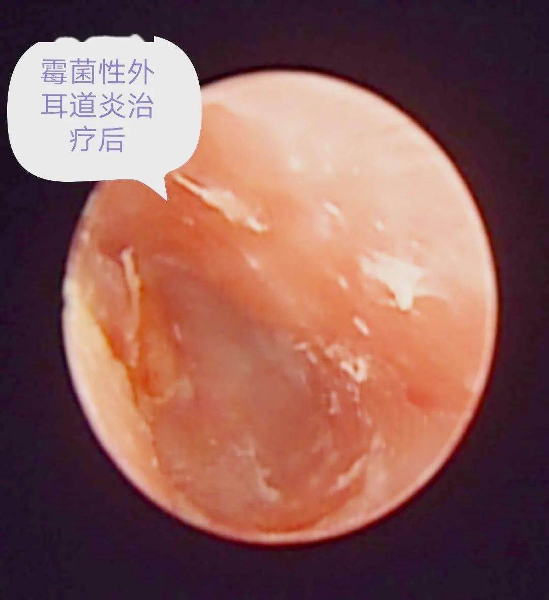 在内镜室,刁护士用耳内镜检查,发现贴近鼓膜处有一白色异物,用专用