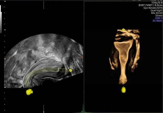 备孕好帮手:四维输卵管造影