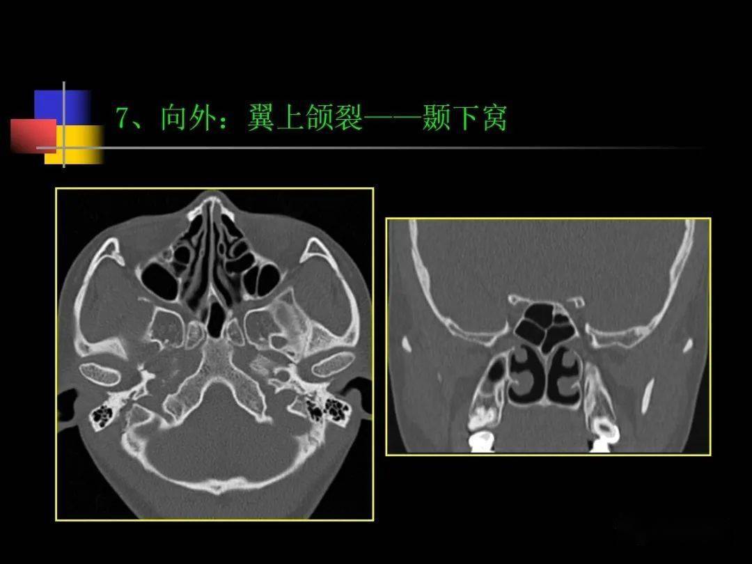 鼻咽部ct解剖