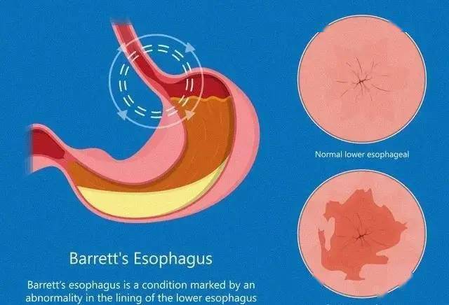 巴雷特食管症状图片图片