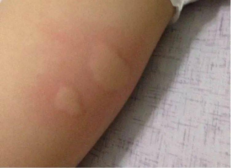 雅正幼活动蚊子远离我雅正幼中班级活动