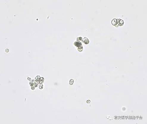 应用爱威(ave)尿液分析仪,审核报告时发现干化学白细胞阴性而沉渣白