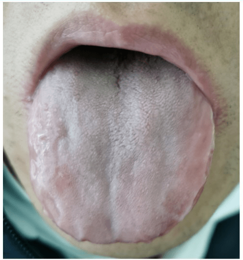 关于舌诊经络定位诊断你学会了吗