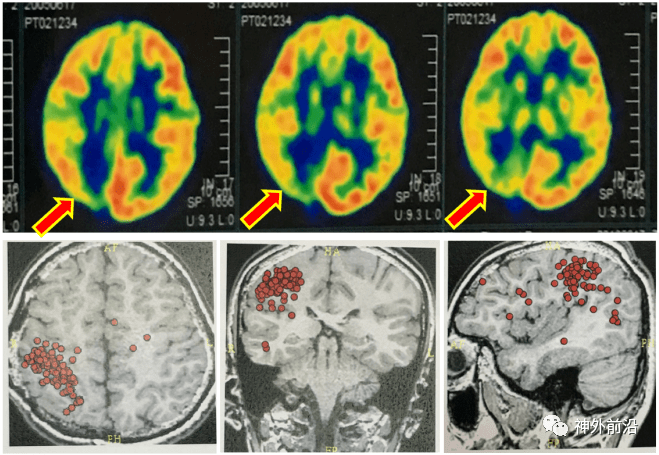 图4-2上图pet箭头所示代代谢可疑癫痫灶区域,下图脑磁图红色圆点为