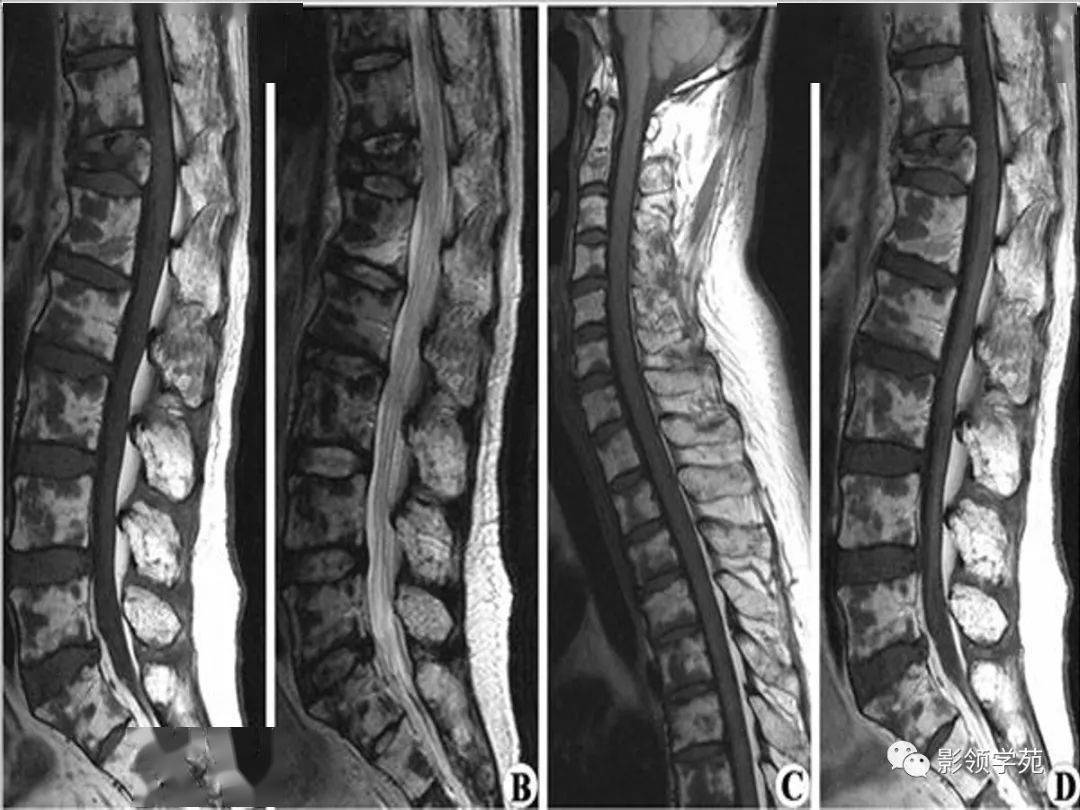 多发性骨髓瘤影像表现