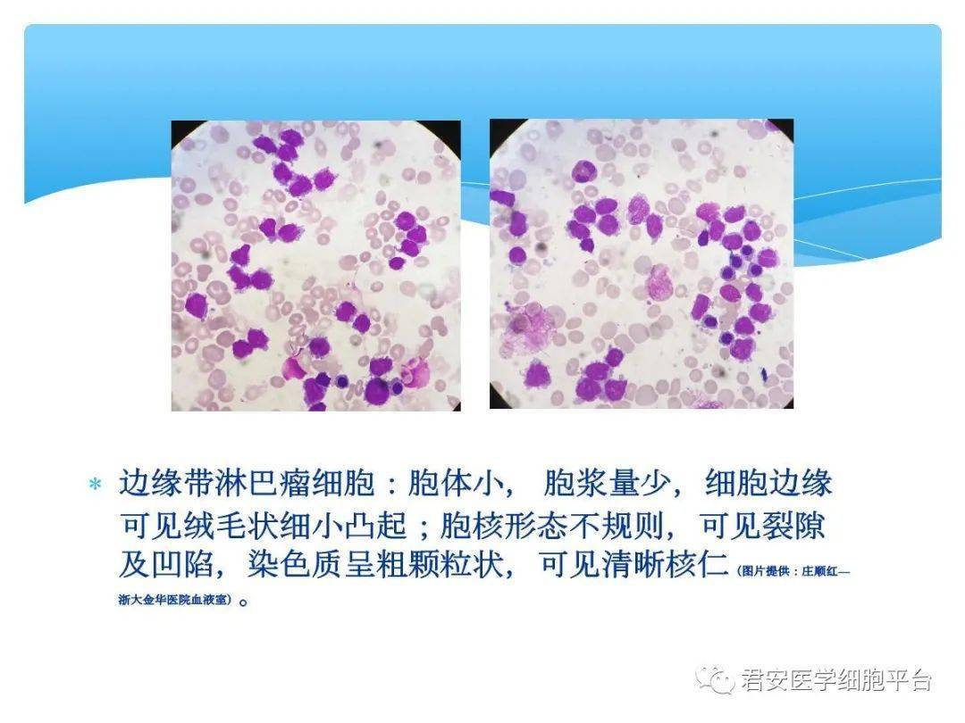 良恶性淋巴细胞形态特点汇总