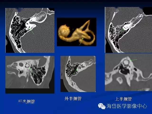 左心耳CT解剖图片