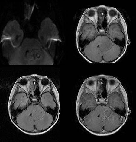 儿童后颅窝占位你想知道的全在这里