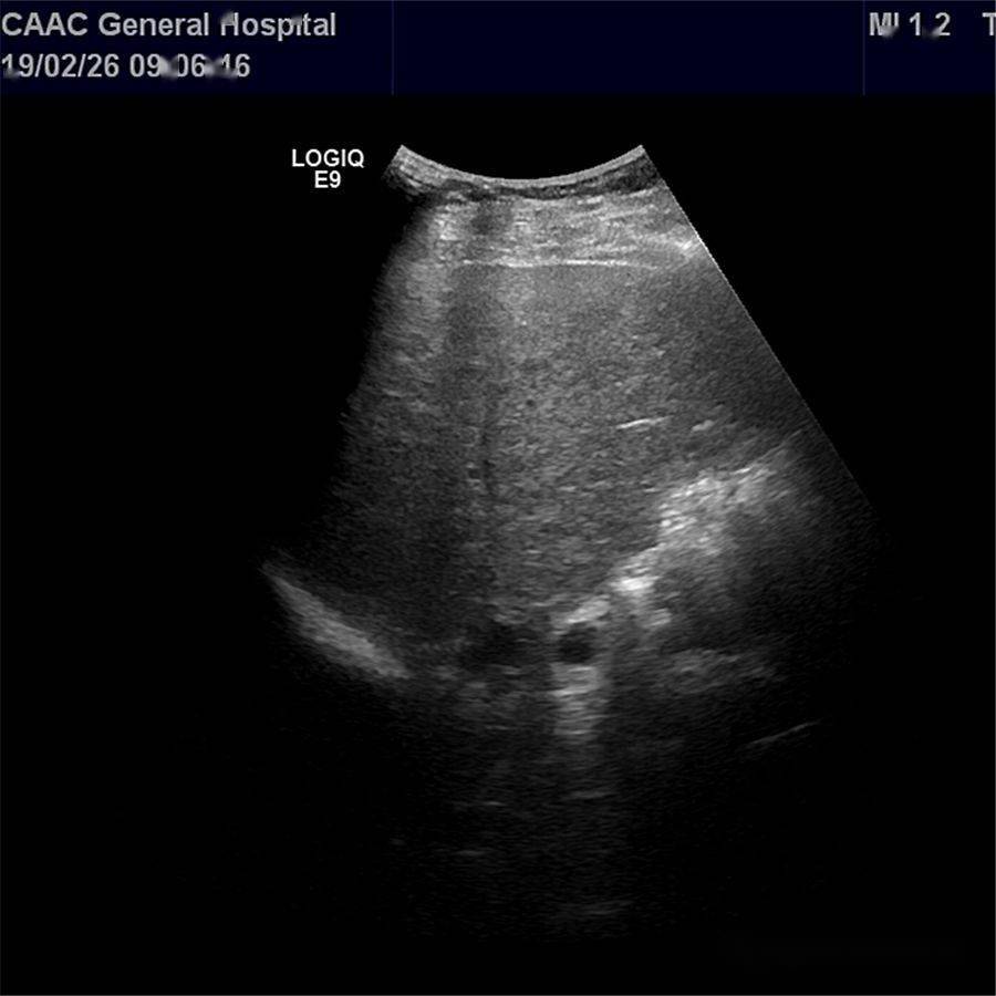 超声随响第12期肝豆状核变性wilsonsdisease