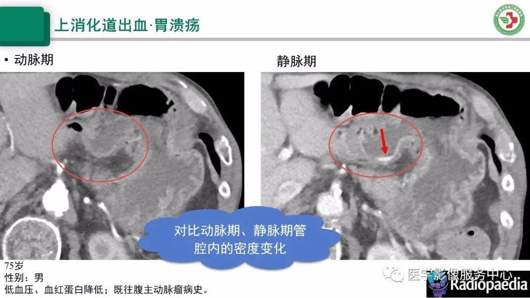 上消化道出血的ct诊断