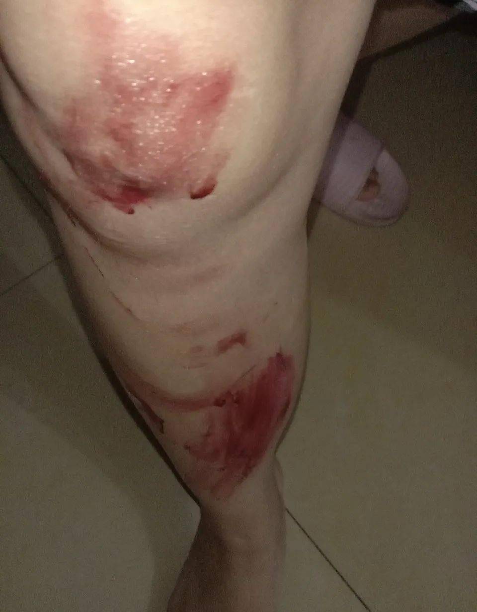 女生腿出血图片图片