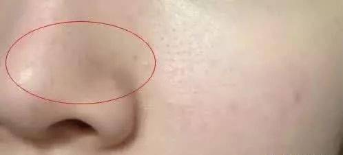 较大的毛孔会堆积大量的皮脂及代谢脱落的细胞,这些皮脂及死细胞在与