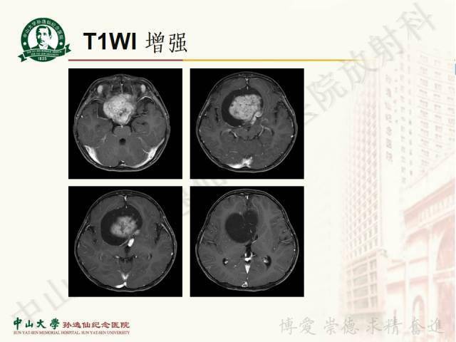 每日一例1165男2歲發作性頭痛伴右眼斜視1年餘加重1月