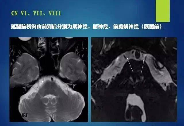 最全的12對顱神經解剖及影像