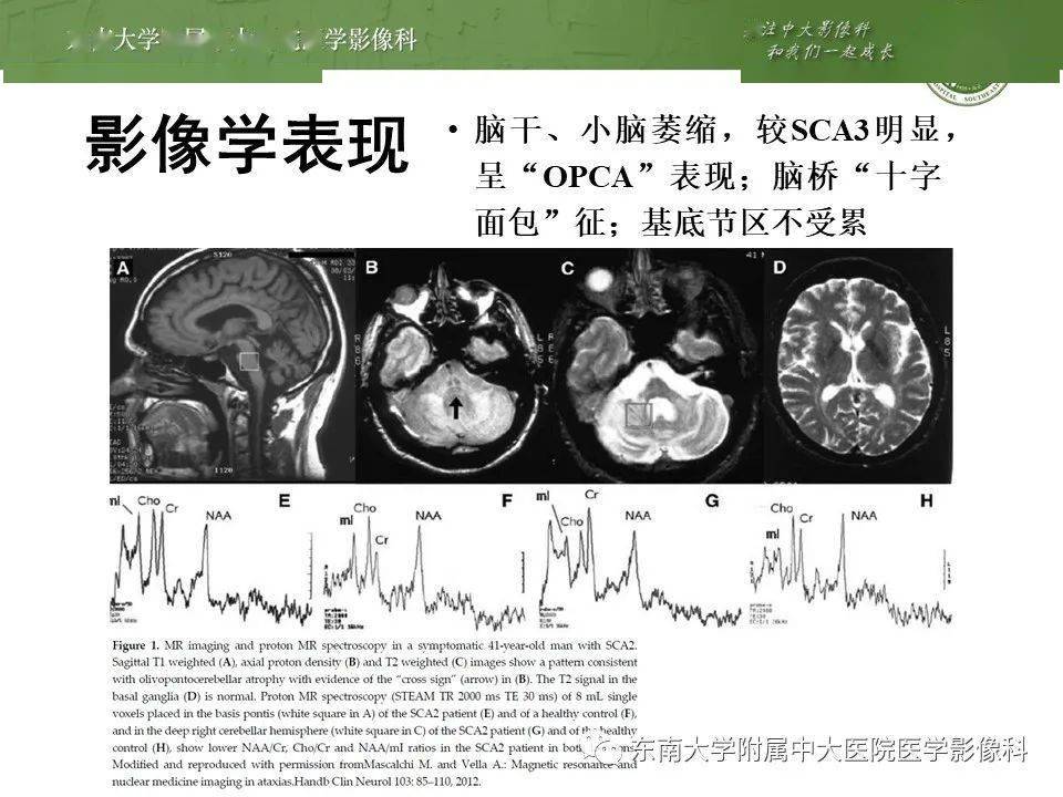 神经系统疾病脊髓小脑性共济失调