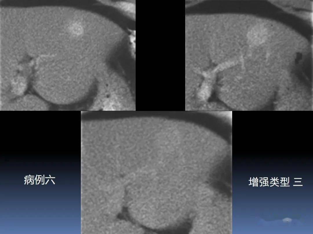 FNH的影像诊断_动脉