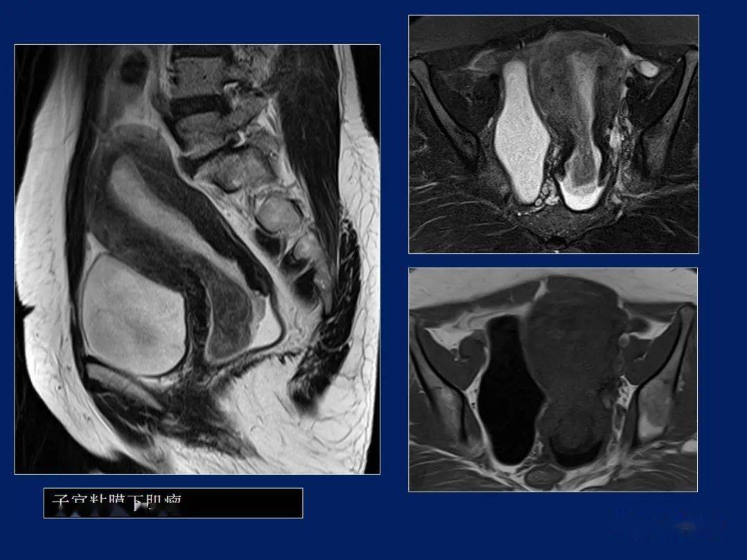 妇产科常见疾病mri表现