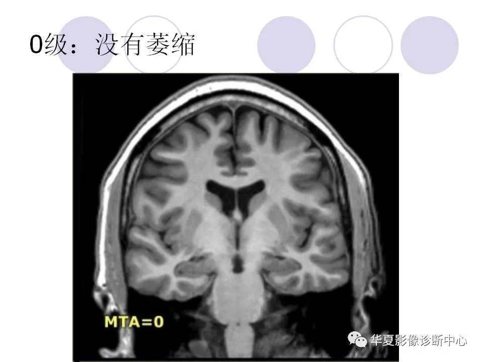 核磁共振海马解剖图图片