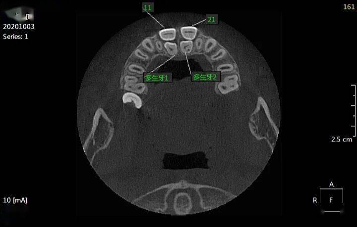 焦xx 20201003 查看多生牙  180xxxx1508