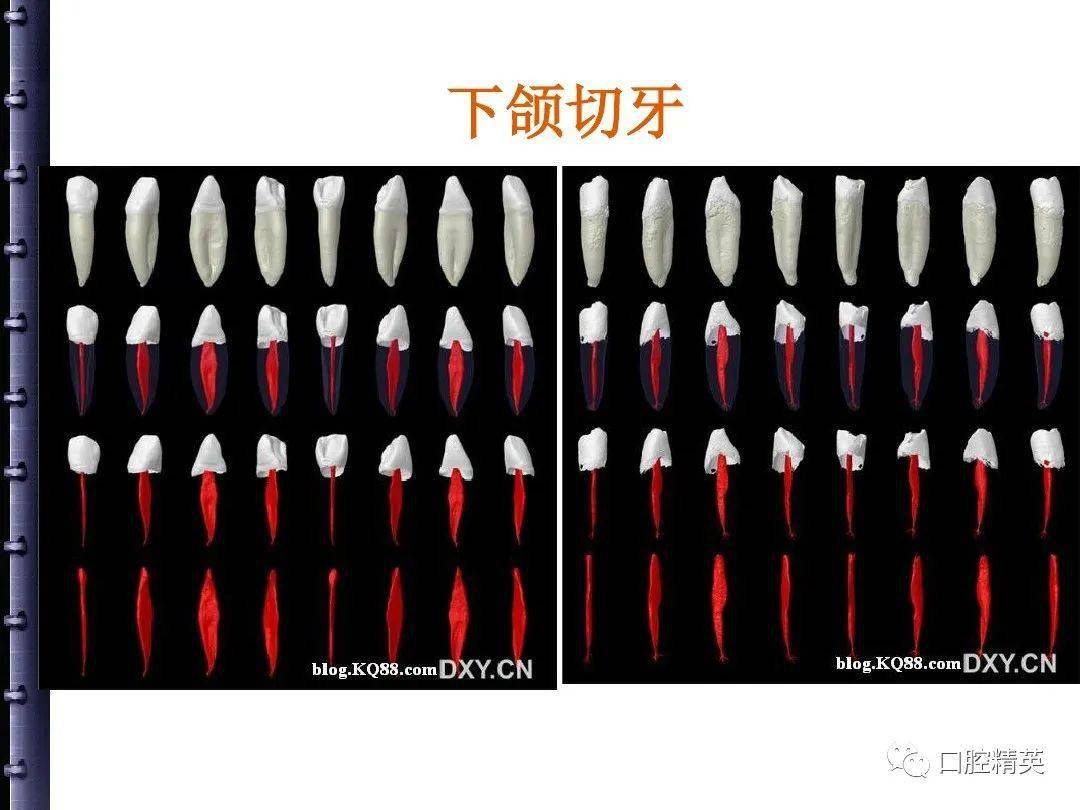 根管治療的步驟方法器械