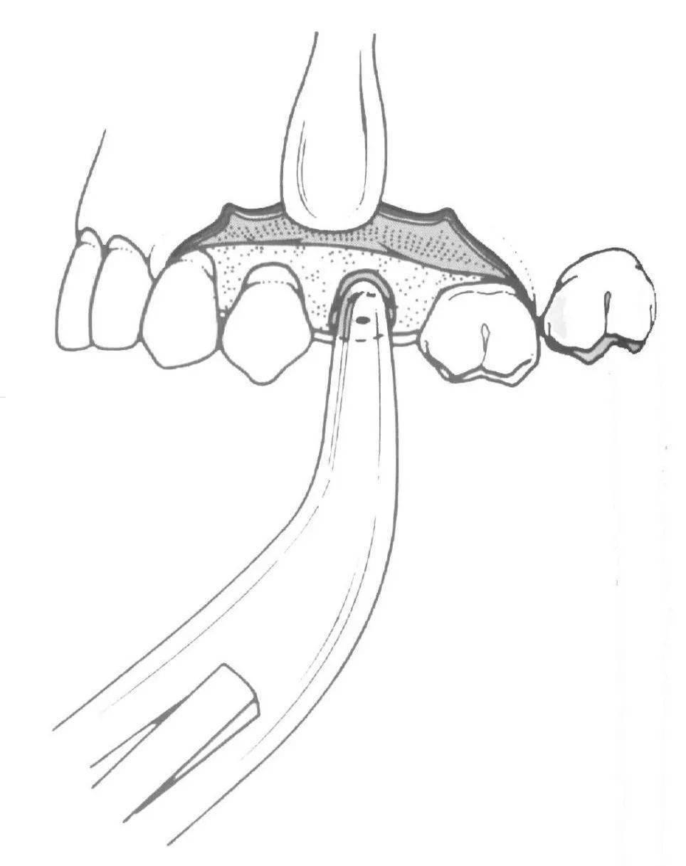 牙根怎么拔图片
