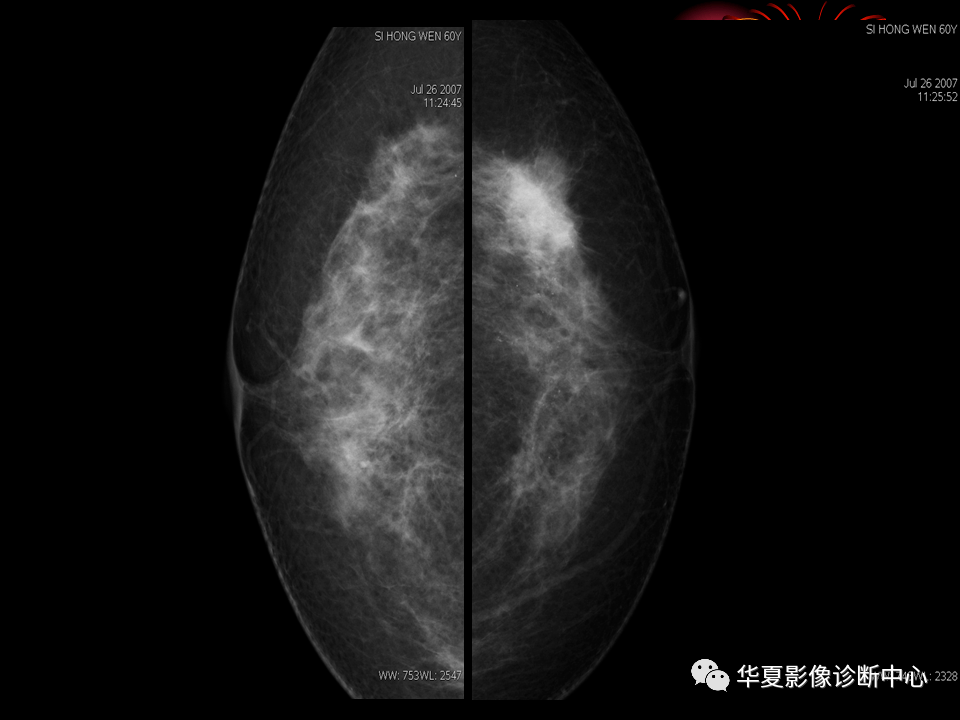 乳腺数字化钼靶x线诊断的临床应用