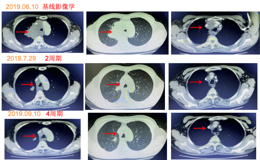 注射用替莫唑胺治療小細胞肺癌腦轉移病例1例