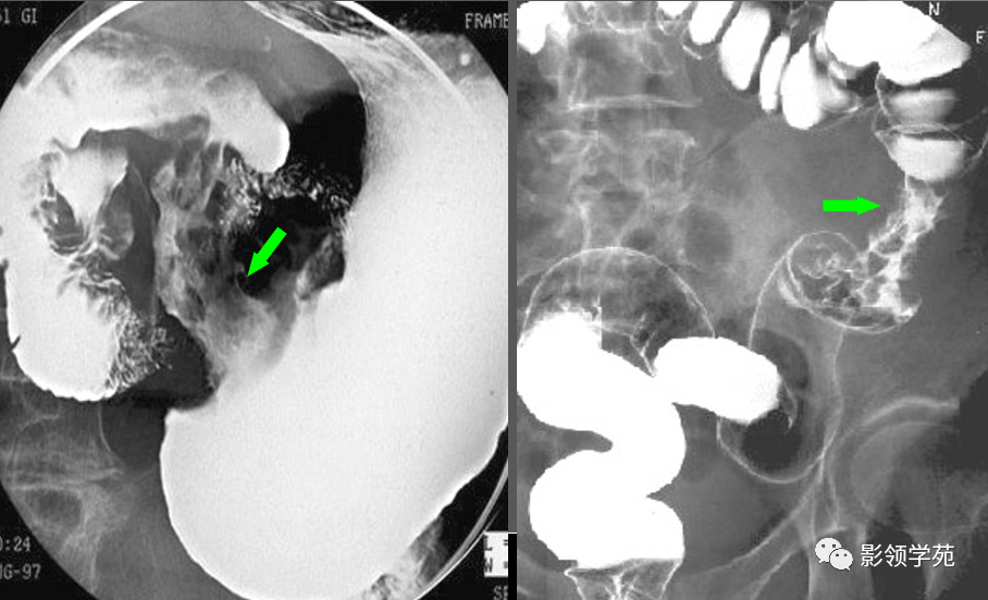 【汇总】消化道疾病影像诊断与鉴别_造影