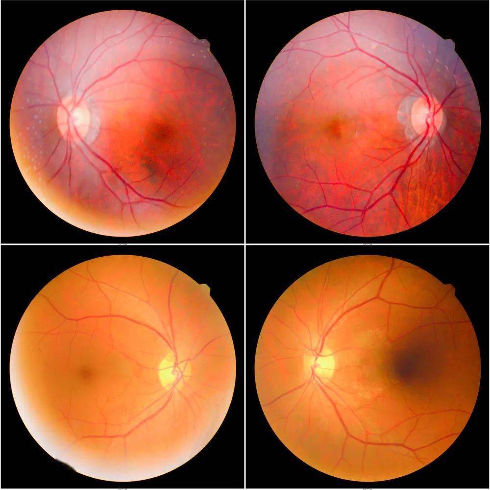 32岁小伙检查眼睛发现患上高血压 肾衰竭,年轻人别不当回事!