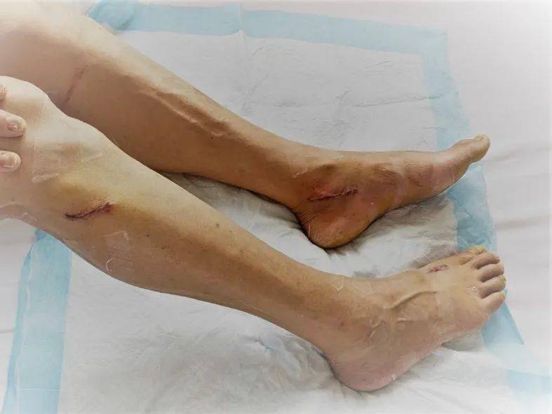 神经减压术让糖尿病患者治足常乐