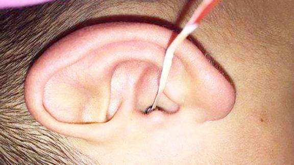 耳朵进小虫子可别随便掏教你正确取出虫子应急法