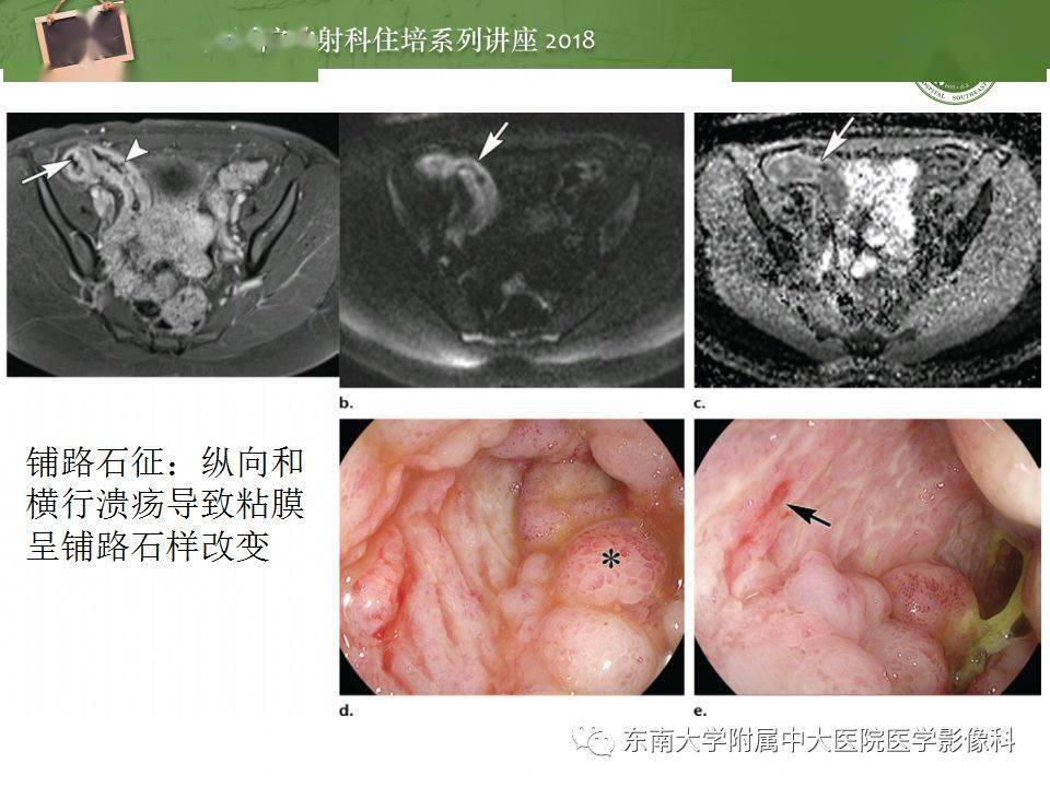 炎症性腸病的影像診斷與評價_醫學