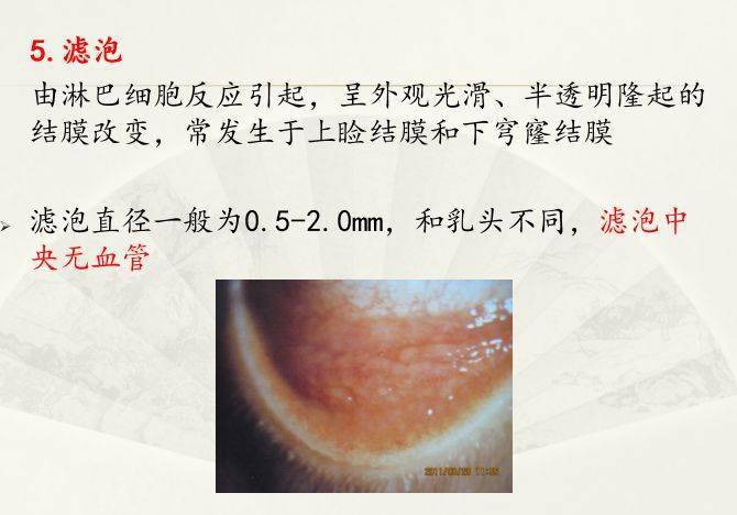 睑板腺滤泡图片